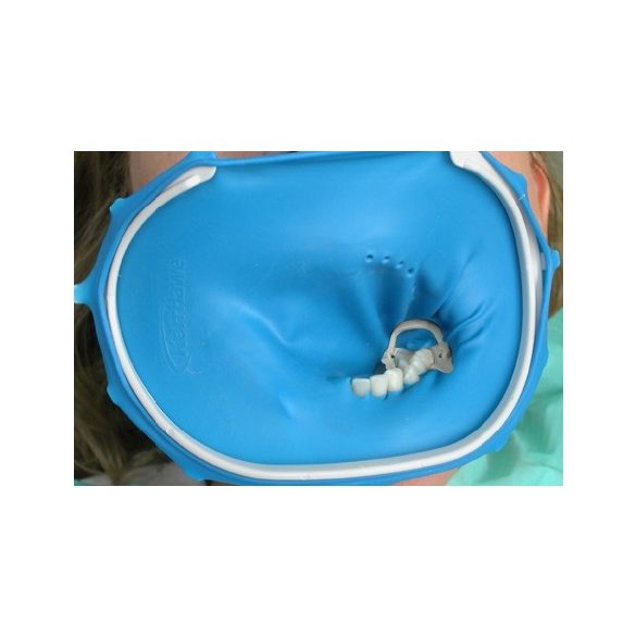 OptiDam Posterior Intro Kit