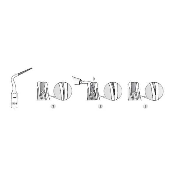 E3D Endodonciás depurátor hegy 