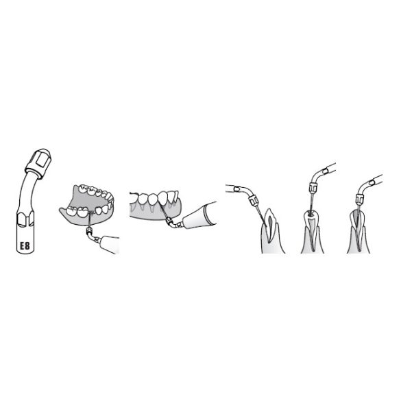 E8 Endodonciás depurátor befogó