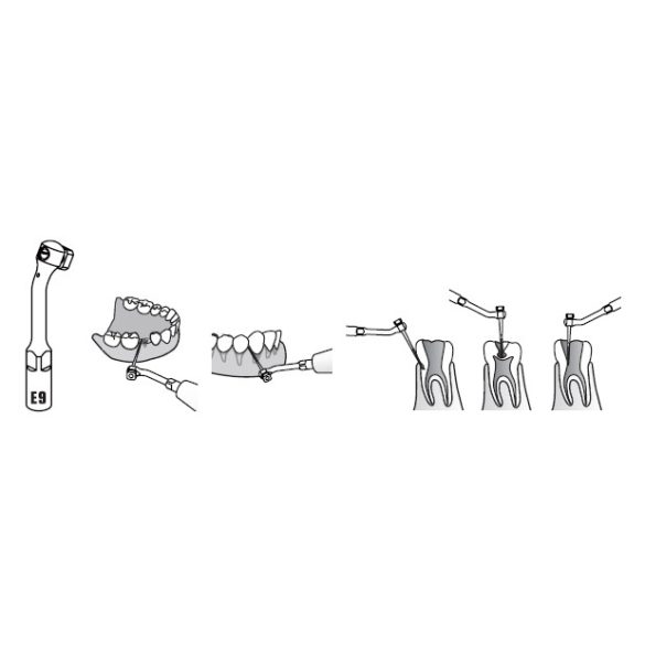 E9 Endodonciás depurátor befogó